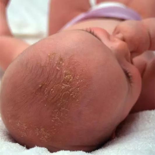 Understanding Cradle Cap